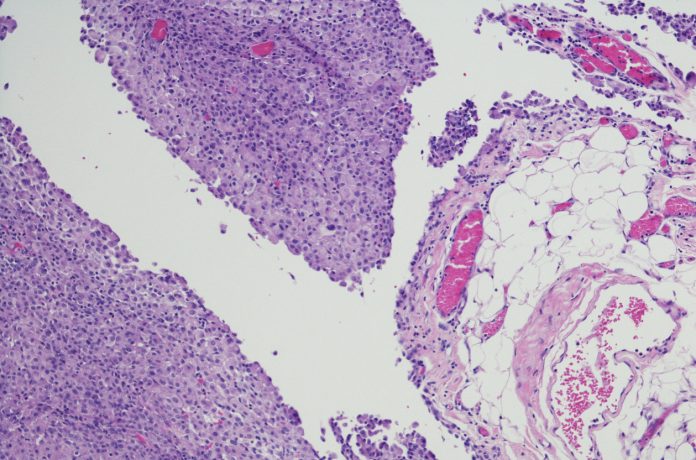 Micrograph of peritoneal Mesothelioma.