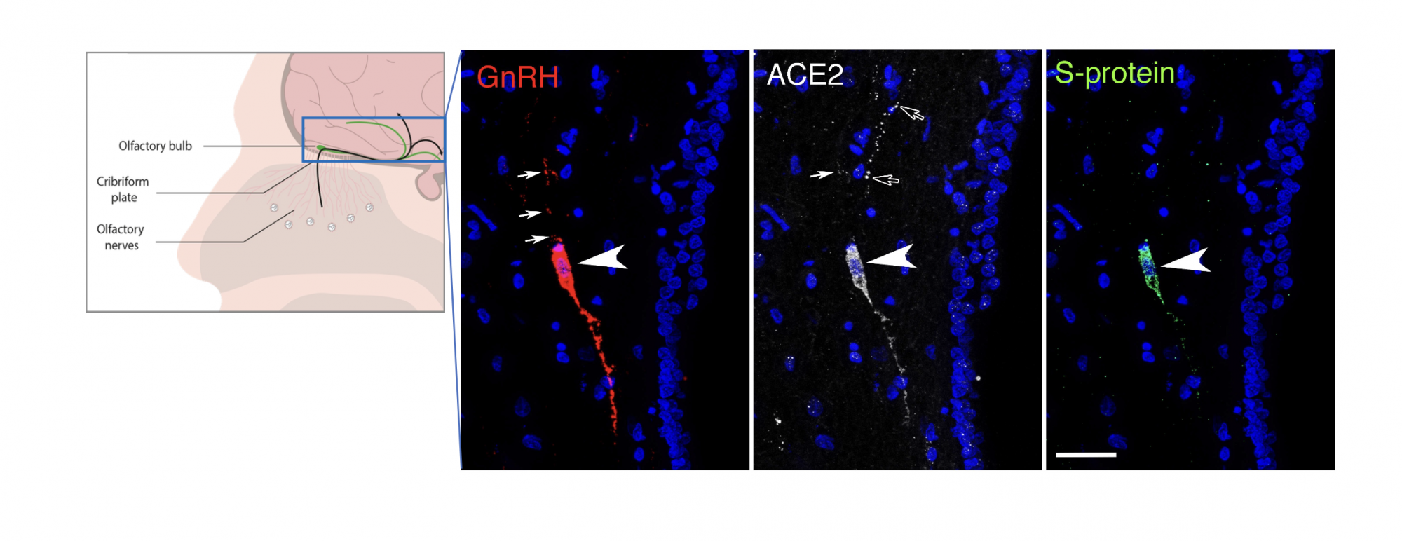 Figure 2. A GnRH neuron (identified by its expression of GnRH, red) in the brain of a patient who died following infection. The neuron expresses the molecule ACE2 (white) used by the virus to enter most target cells. The presence of the viral spike protein (green), a protein on the surface of the virus that attaches to the target cell, in the same cell indicates that it is infected and producing more viruses. In blue, the nuclei of this and surrounding brain cells. 