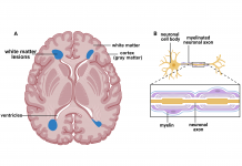 Fig. 1 White matter hyperintensities (illustrated in blue) in a representative image of the human brain (A) are primarily found near ventricles. The neuronal cell bodies are found mainly in the cortex (gray matter) and myelinated neuronal axons in the white matter (B). Figure created using BioRender.