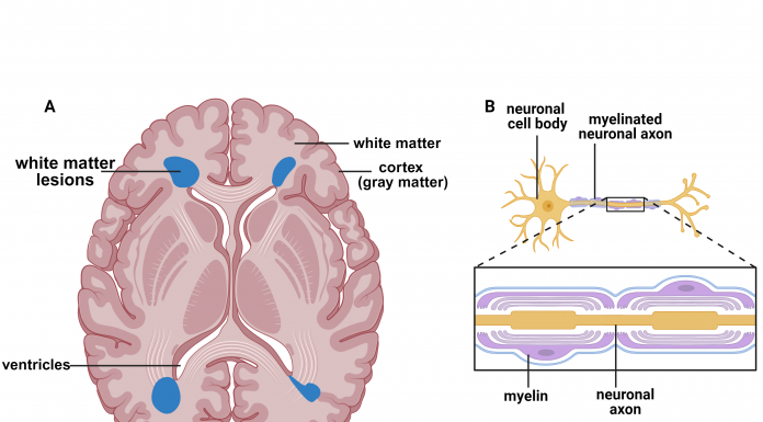 Fig. 1 White matter hyperintensities (illustrated in blue) in a representative image of the human brain (A) are primarily found near ventricles. The neuronal cell bodies are found mainly in the cortex (gray matter) and myelinated neuronal axons in the white matter (B). Figure created using BioRender.