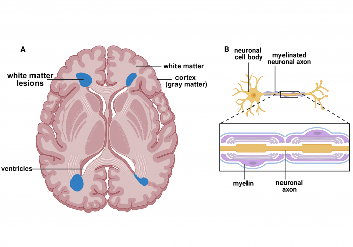 Fig. 1 White matter hyperintensities (illustrated in blue) in a representative image of the human brain (A) are primarily found near ventricles. The neuronal cell bodies are found mainly in the cortex (gray matter) and myelinated neuronal axons in the white matter (B). Figure created using BioRender.