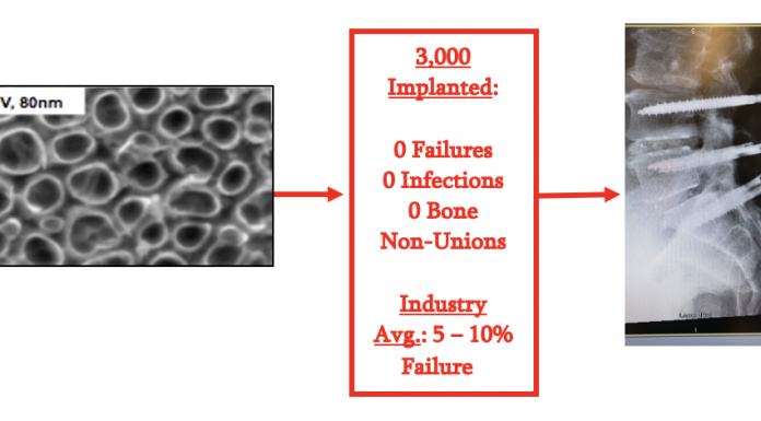 Figure 1: Early research at Purdue University in the Webster lab that led to the formation of Nanovis, which now has over 3,000 FortiFixTM pedicle screws inserted in humans with no cases of implant failure, according to the Maude database. The industry standard of pedicle screw failures lies between 5 – 10% depending on the data assessed.