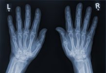 X-ray image of the hands of a senior woman with Osteoarthritis. Human skeleton.