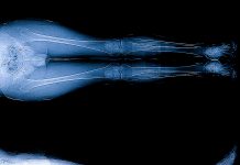 Scanogram is a Full-length standing AP radiograph of both lower extremities including the hip, knee, and ankle