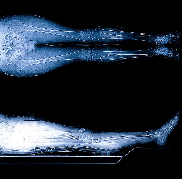 Scanogram is a Full-length standing AP radiograph of both lower extremities including the hip, knee, and ankle