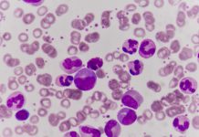Leukemia blood cells medical science background concept.