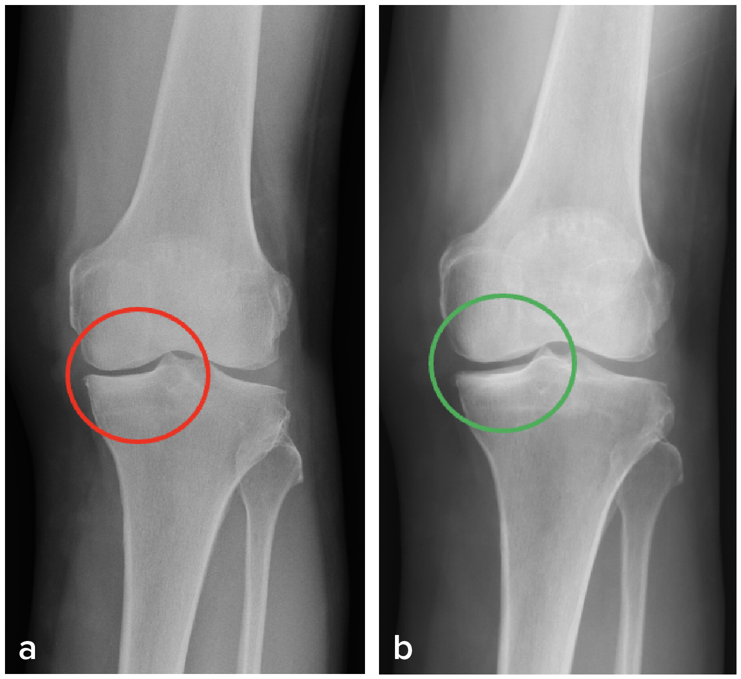 Figure 2. Another example of how SKC stops knee cartilage degeneration and facilitates its regeneration can be found in a 61-year-old male patient having stage III OA over the medial compartment of both his knees (a). We recommended that he practices SKC. One year later, obvious improvements in the radiographic manifestation could be observed in both his knees (b).