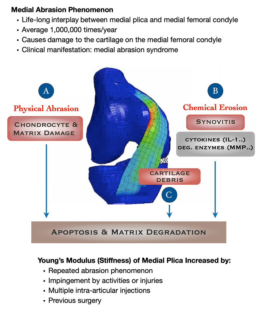 Figure 1. Medial abrasion phenomenon as a cause of knee osteoarthritis