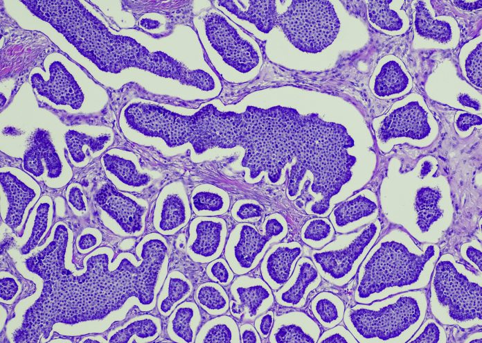 Carcinoid tumors are a type of slow-growing cancer that can arise in several places throughout your body. Carcinoid tumors, which are one subset of tumors called neuroendocrine tumors, usually begin in the digestive tract (stomach, appendix, small intestine, colon, rectum) or in the lungs. Site: Ovary