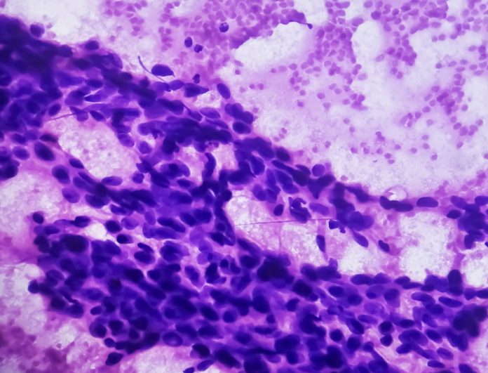 FNAC of breast lump showing ductal carcinoma
