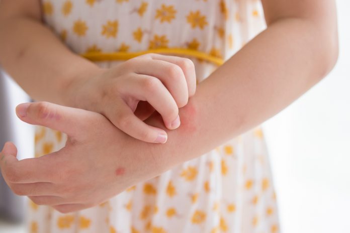 Little girl has skin rash allergy itching and scratching on her arm