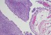 Micrograph of peritoneal Mesothelioma.