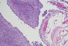 Micrograph of peritoneal Mesothelioma.