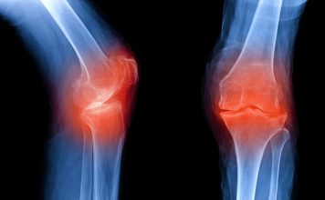 Osteoarthritis knee . film x-ray AP ( anterior - posterior ) and lateral view show narrow joint space, osteophyte ( spur ), subchondral sclerosis, inflammation, OA