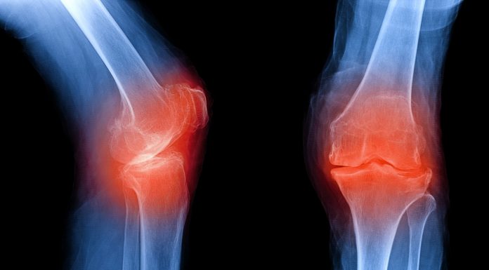 Osteoarthritis knee . film x-ray AP ( anterior - posterior ) and lateral view show narrow joint space, osteophyte ( spur ), subchondral sclerosis, inflammation, OA