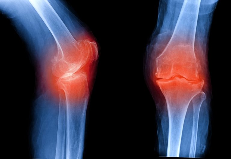 Osteoarthritis knee . film x-ray AP ( anterior - posterior ) and lateral view show narrow joint space, osteophyte ( spur ), subchondral sclerosis, inflammation, OA