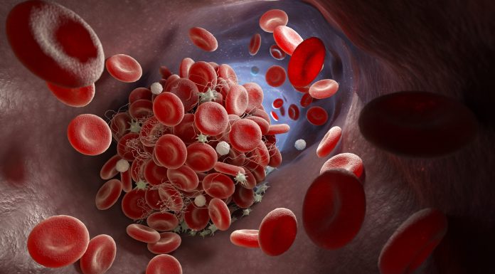 Depiction of a blood clot forming inside a blood vessel. 3D illustration, patients with haematological cancers