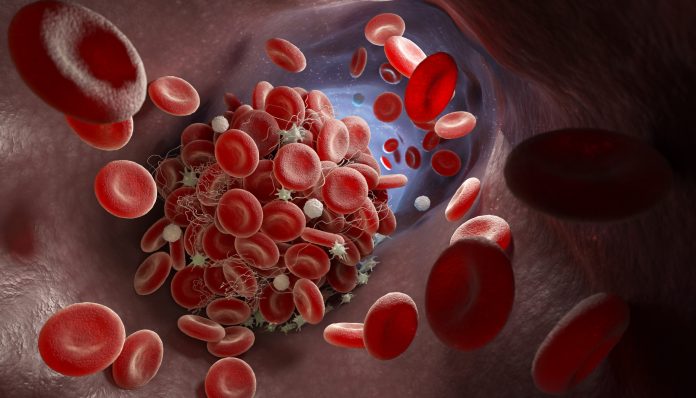 Depiction of a blood clot forming inside a blood vessel. 3D illustration, patients with haematological cancers