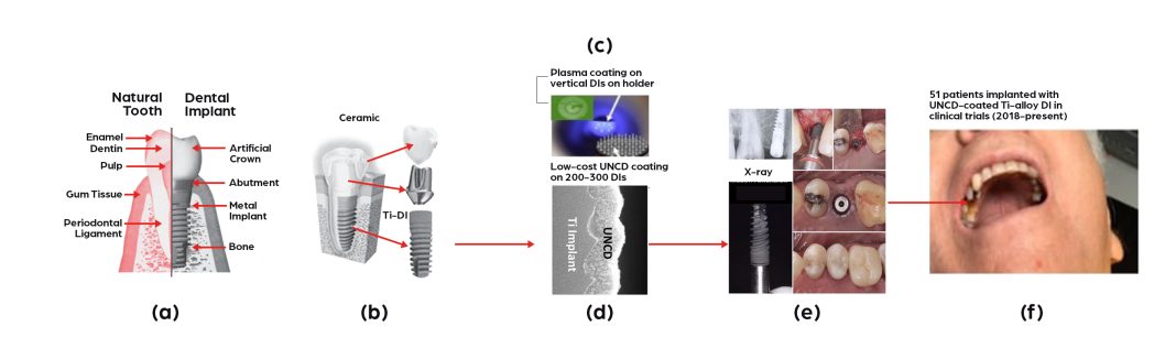 Figure 1. a) schematic of natural tooth and artificial DI; b) schematic of Ti-alloy DI; c) picture showing green plasma and array of vertical Ti-alloy DIs being coated (also shown is a schematic of industrial large array of DIs projected for low-cost fabrication of UNCDTM-coated DIs); d) cross-section SEM image of UNCDTM-coated Ti-alloy DI; e) X-ray and optical images of UNCD-coated DI in patient’s mouth; f) picture of patient with implanted UNCDTM -coated DI, including test demonstrating excellent osseointegration.