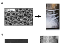 Figure 1: a) Nanotextured spinal implants now in over 30,000 humans with no cases of failure [2]. Such implants are being commercialized by Nanovis. b) Nanosensors now being used to detect the presence of bacteria, inflammatory cells, or bone-forming cells on implants. Such nanosensors can communicate to handheld devices and can respond in real-time to reverse adverse events. Such sensors have been implanted in sheep for up to 12 weeks showing the ability to promote bone growth.