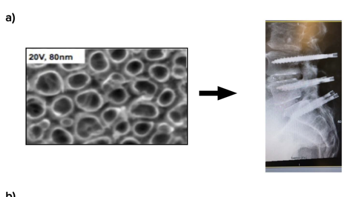 Figure 1: a) Nanotextured spinal implants now in over 30,000 humans with no cases of failure [2]. Such implants are being commercialized by Nanovis. b) Nanosensors now being used to detect the presence of bacteria, inflammatory cells, or bone-forming cells on implants. Such nanosensors can communicate to handheld devices and can respond in real-time to reverse adverse events. Such sensors have been implanted in sheep for up to 12 weeks showing the ability to promote bone growth.