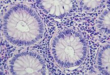 Colon cancer microscopic photography, magnification x400