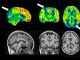 A case study of arterial spin labelling (ASL), revealing the characteristic patterns of Alzheimer’s disease (shown with white arrows). The image is similar to what would be obtained with a PET scan (not shown); conversely, a standard MRI of the same patient does not yet show sufficient abnormality to make a diagnosis.
