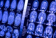 MRI of brain of a healthy person with blue illumination. Magnetic resonance scan. Medical healthcare concept