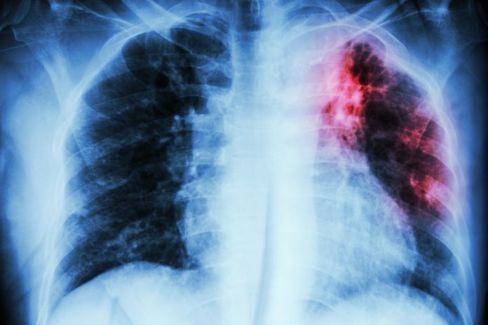 Pulmonary Tuberculosis . Chest X-ray : interstitial infiltration at left upper lung due to Mycobacterium Tuberculosis infection v