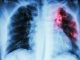Pulmonary Tuberculosis . Chest X-ray : interstitial infiltration at left upper lung due to Mycobacterium Tuberculosis infection v