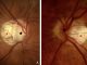 Figure 1. photo of a peripapillary intrachoroidal cavitation. The crescent-shaped atrophic area (red star), at the border of the optic nerve head (black star), called myopic conus, is alone in (A). It presents a circumscribed, yellow-orange lesion (white star) at its outer border in (B), corresponding to the peripapillary intrachoroidal cavitation. Note: Figures 1 and 2 are reprinted from Peripapillary Intrachoroidal Cavitation. Adèle Ehongo et al. ‘J. Clin. Med. 2023, 12, 4712’ Originally published by and used with permission from MDPI.