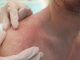 The doctor's hands touch the burn on the man's shoulders, close-up. Allergy to the sun, dermatological diseases