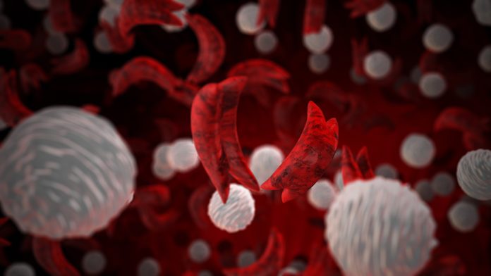 Sickle cells with white cells medical concept
