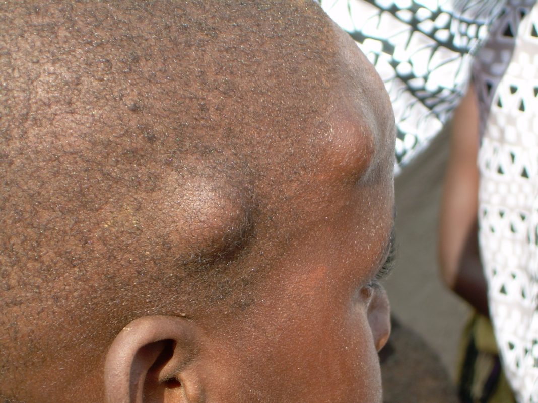 Worm nodules containing Onchocerca volvulus, the filarial species causing river blindness if not treated, on the head of a 5 year-old boy