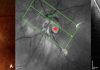 Figure 1. Peripapillary intrachoroidal cavitation (PICC) with a full-thickness defect within the myopic conus. (A). Fundus image showing a circumscribed yellow-orange lesion (black star) at the outer and inferior border of the myopic conus, corresponding to a peripapillary intrachoroidal cavitation. A full-thickness defect (red star) is located within the myopic conus. (B) Section along the green arrow of the infrared image, through the full-thickness defect (red star). The remnant of nerve fibers (yellow arrow) herniate into the PICC cavity. ONH = optic nerve head. Note: Reprinted from Peripapillary Intrachoroidal Cavitation. Adèle Ehongo et al. ‘J. Clin. Med. 2023, 12, 4712’ Originally published by and used with permission from MDPI.