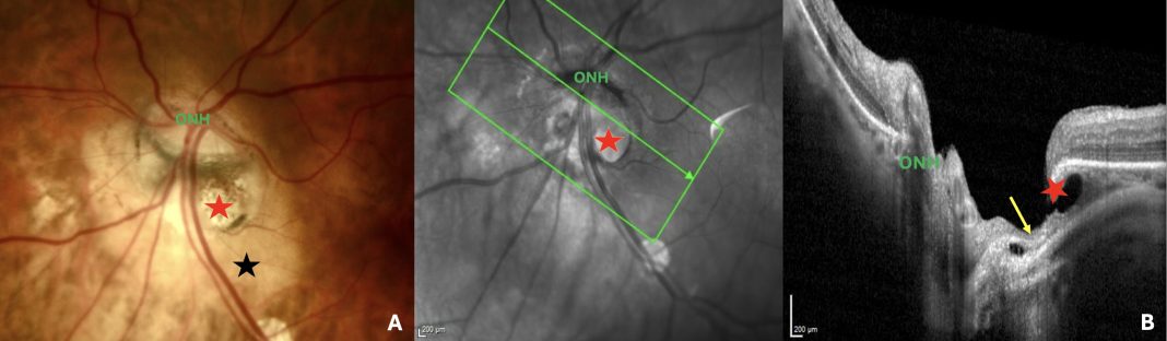 Figure 1. Peripapillary intrachoroidal cavitation (PICC) with a full-thickness defect within the myopic conus. (A). Fundus image showing a circumscribed yellow-orange lesion (black star) at the outer and inferior border of the myopic conus, corresponding to a peripapillary intrachoroidal cavitation. A full-thickness defect (red star) is located within the myopic conus. (B) Section along the green arrow of the infrared image, through the full-thickness defect (red star). The remnant of nerve fibers (yellow arrow) herniate into the PICC cavity. ONH = optic nerve head. Note: Reprinted from Peripapillary Intrachoroidal Cavitation. Adèle Ehongo et al. ‘J. Clin. Med. 2023, 12, 4712’ Originally published by and used with permission from MDPI.