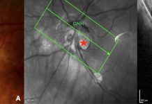 Figure 1. Peripapillary intrachoroidal cavitation (PICC) with a full-thickness defect within the myopic conus. (A). Fundus image showing a circumscribed yellow-orange lesion (black star) at the outer and inferior border of the myopic conus, corresponding to a peripapillary intrachoroidal cavitation. A full-thickness defect (red star) is located within the myopic conus. (B) Section along the green arrow of the infrared image, through the full-thickness defect (red star). The remnant of nerve fibers (yellow arrow) herniate into the PICC cavity. ONH = optic nerve head. Note: Reprinted from Peripapillary Intrachoroidal Cavitation. Adèle Ehongo et al. ‘J. Clin. Med. 2023, 12, 4712’ Originally published by and used with permission from MDPI.