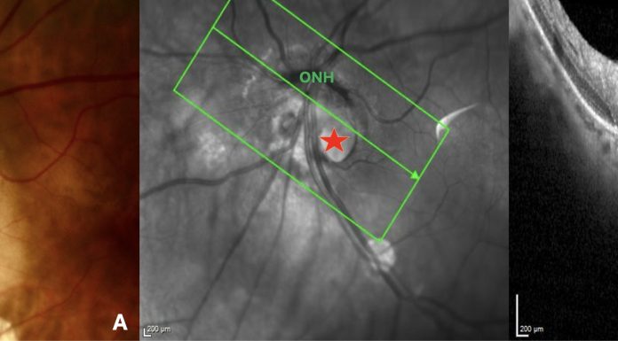 Figure 1. Peripapillary intrachoroidal cavitation (PICC) with a full-thickness defect within the myopic conus. (A). Fundus image showing a circumscribed yellow-orange lesion (black star) at the outer and inferior border of the myopic conus, corresponding to a peripapillary intrachoroidal cavitation. A full-thickness defect (red star) is located within the myopic conus. (B) Section along the green arrow of the infrared image, through the full-thickness defect (red star). The remnant of nerve fibers (yellow arrow) herniate into the PICC cavity. ONH = optic nerve head. Note: Reprinted from Peripapillary Intrachoroidal Cavitation. Adèle Ehongo et al. ‘J. Clin. Med. 2023, 12, 4712’ Originally published by and used with permission from MDPI.