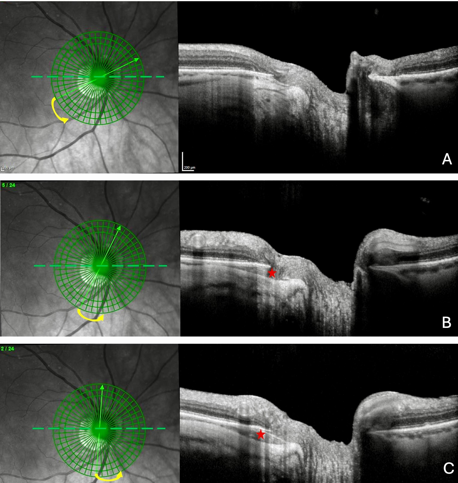 Figure 2. From (A) to (C). Successive clicks (yellow arrows) along radial optical coherence tomography slices of the optic nerve head revealing the peripapillary intrachoroidal cavitation (red star). The device used is the Spectral Domain OCT Spectralis® HRA-OCT, model S3300 (Heidelberg Engineering GmbH, Heidelberg Germany). Note: Reprinted from Peripapillary Intrachoroidal Cavitation. Adèle Ehongo et al. ‘J. Clin. Med. 2023, 12, 4712’ Originally published by and used with permission from MDPI.
