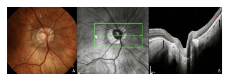 Figure 1. OCT features of a peripapillary staphyloma (PPS). (A) Fundus image. The PPS shows slight pigmentary changes at its edges (blue lines). (B) The optical coherence tomography section is along the arrow in the infrared image. The sclera between the black arrows, including the optic nerve is bowed posteriorly with a steeper local curvature than adjacent scleral regions. The choroid shows thinning (between red arrowhead and black arrow) at the edges of PPS, followed by a rethickening towards the optic nerve. Abbreviation: PPS = peripapillary staphyloma. Source. Ehongo A. Doctoral thesis in Medical science (2024). Free University of Brussels. Optical coherence tomography analysis of peripapillary intrachoroidal cavitation. Clinical implications for highly myopic eyes, page 20.