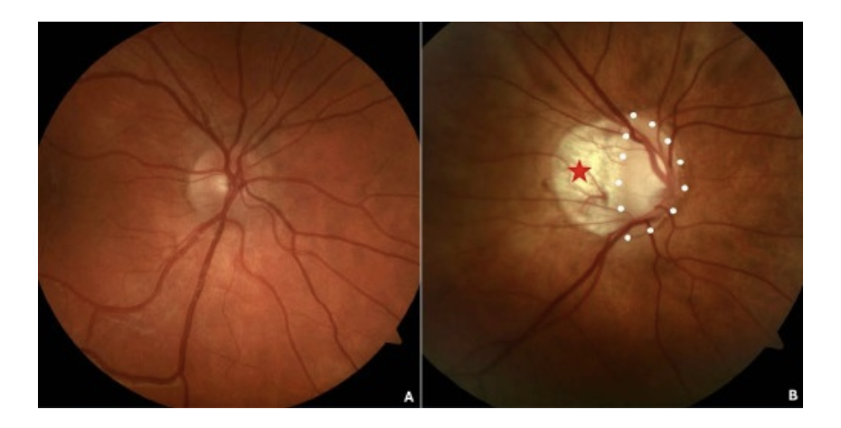 Figure 2. Fundus image illustrating a myopic oval disc. (A) A slightly oval non-myopic disc. (B) A myopic optic disc with a pronounced oval configuration (dotted white line) and a temporal conus (red star). (myopic conus = crescent). Source. Ehongo A. Doctoral thesis in Medical science (2024). Free University of Brussels. Optical Coherence Tomography analysis of Peripapillary intrachoroidal cavitation. Clinical implications for highly myopic eyes, page 23.