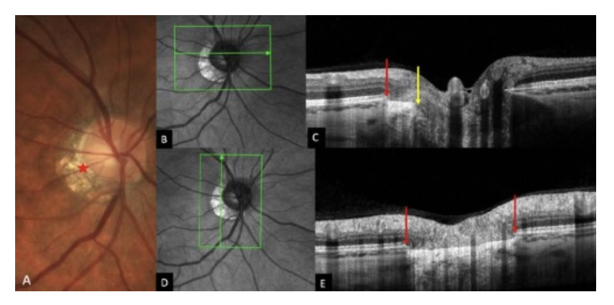 Figure 3. Myopic conus = Gamma Peripapillary atrophy (γPPA). (A) Fundus image of an eye exhibiting a γPPA (red star). (B) Infra-red image with the green arrow indicating the location of section (C). (C) There is a disparity between the end of Bruch’s membrane (red arow) and the scleral opening (yellow arrow). γPPA is between the yellow and red arrows. (D) Infra-red image with the green arrow indicating the location of section (E). (E) γPPA is between the ends of BM (red arrows). Abbreviation: Gamma Peripapillary atrophy = γPPA. Source. Ehongo A. Doctoral thesis in Medical science (2024). Free University of Brussels. Optical coherence tomography analysis of peripapillary intrachoroidal Optical Coherence Tomography analysis of Peripapillary intrachoroidal cavitation. Clinical implications for highly myopic eyes, page 67.