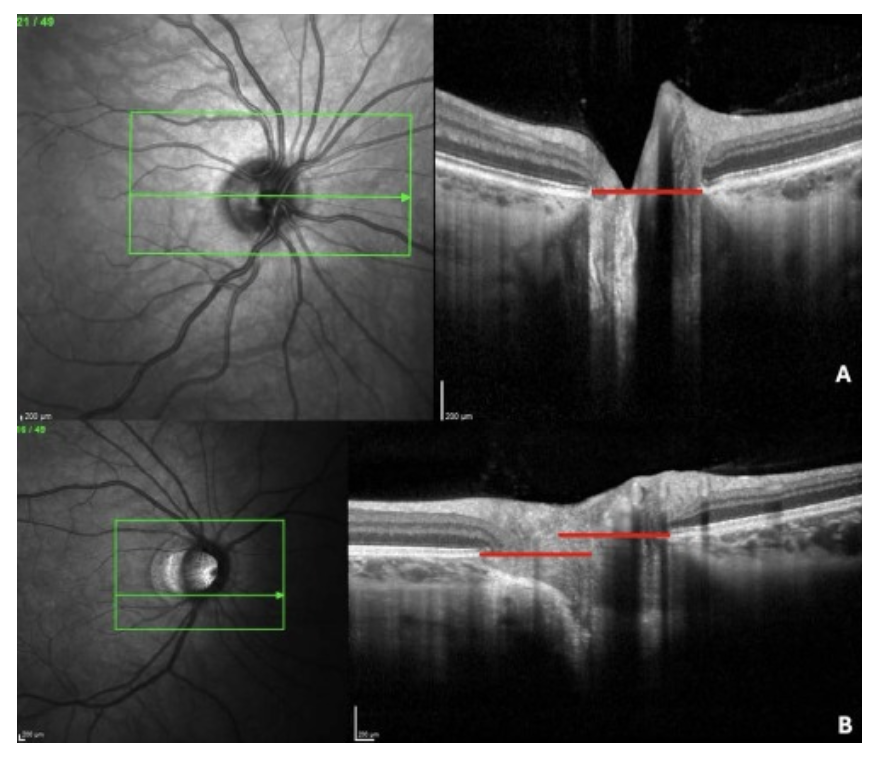 Figure 4. Myopic optic disc. Posterior positioning of the side with Gamma Peripapillary atrophy (γPPA). Sections are along the green arrow in the infrared image. (A). Slightly oval non-myopic optic disc. Both sides are in the same plane (highlighted by the red line). (B) Myopic optic disc with a pronounced oval configuration. The relative posterior positioning of the side of the optic disc with γPPA compared to the opposite side is highlighted by the space between the red lines. Source: Ehongo A. Doctoral thesis in medical sciences (2024). Free University of Brussels. Optical coherence tomography analysis of peripapillary intrachoroidal cavitation. Clinical implications for highly myopic eyes. Presentation to the public defense.