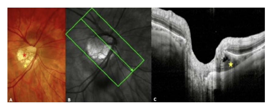Figure 5. Peripapillary intrachoroidal cavitation. (A) Fundus image. Myopic conus = red star. (B) Infrared image with the green arrow showing the location of the slide (C). (C) The Peripapillary intrachoroidal cavitation is the intrachoroidal hyporeflective triangular thickening with the base against the optic nerve. It is highlighted by the yellow star in A and C. Source. Ehongo A. Doctoral thesis in Medical science (2024). Free University of Brussels. Optical coherence tomography analysis of peripapillary intrachoroidal Optical Coherence Tomography analysis of Peripapillary intrachoroidal cavitation. Clinical implications for highly myopic eyes, page 67.