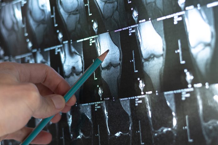 Doctor examining bone knee tumor. X-ray and MRI, MRT, CT with marked sclerosis around the nidus. Medical treatmant concept. Diagnosis of the disease humans bones.