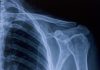 X-ray image of shoulder