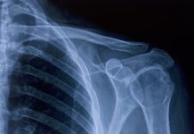 X-ray image of shoulder