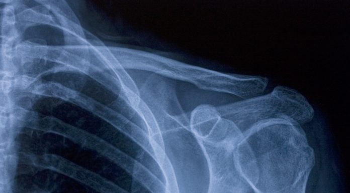 X-ray image of shoulder