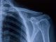 X-ray image of shoulder