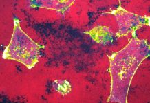 Microscopy image of invasive breast cancer cells (labelled in yellow) degrading their underlying extracellular matrix (labelled gelatin in red, degraded areas appear as black holes). Scale bar, 20µm. Credit Omkar Joshi / Turku Bioscience Centre, University of Turku
